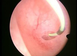 Hysteroscopy